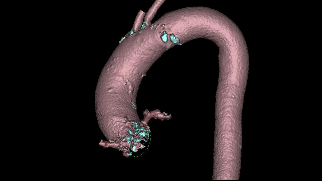 alization-applications-valveplanning-valve-planning-clinical-valve-plan-visualization