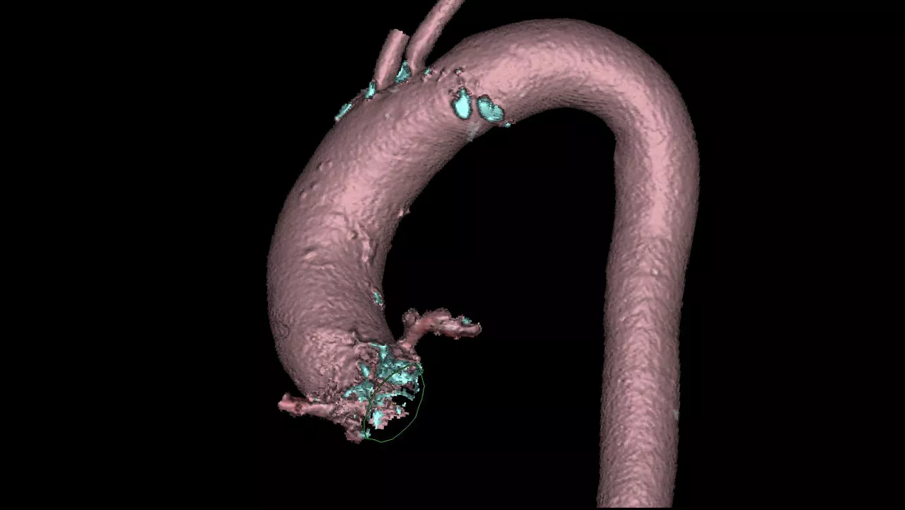 alization-applications-valveplanning-valve-planning-clinical-valve-plan-visualization