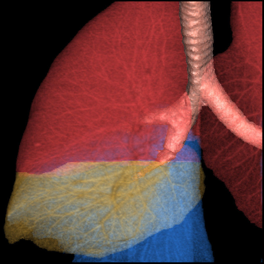 categories-computed-tomography-revolutionhd-gehc-revolution-hd-clinical-images-chest3