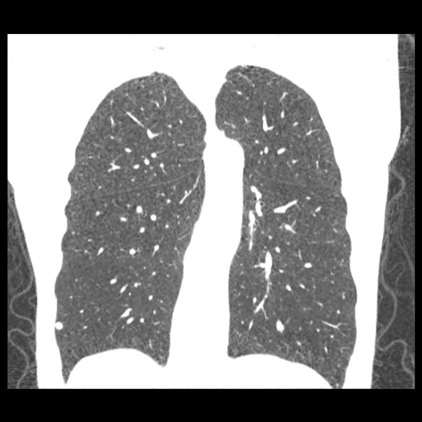 categories-computed-tomography-revolutionhd-gehc-revolution-hd-clinical-images-chest4