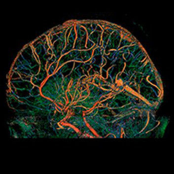 categories-computed-tomography-revolutionhd-gehc-revolution-hd-clinical-images-neuro3