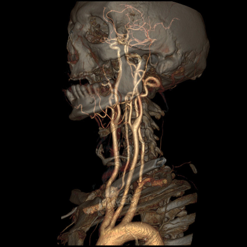 categories-computed-tomography-revolutionhd-gehc-revolution-hd-clinical-images-neuro5