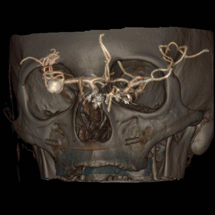 categories-computed-tomography-revolutionhd-gehc-revolution-hd-clinical-images-neuro6