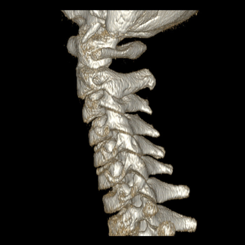 categories-computed-tomography-revolutionhd-gehc-revolution-hd-clinical-images-neuro7
