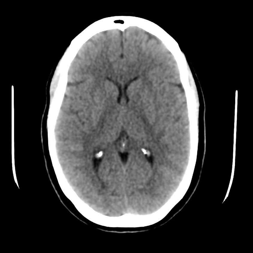 categories-computed-tomography-revolutionhd-gehc-revolution-hd-clinical-images-neuro8