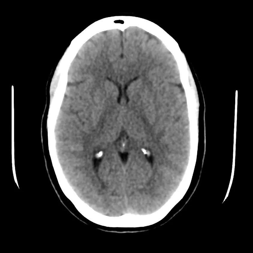categories-computed-tomography-revolutionhd-gehc-revolution-hd-clinical-images-neuro8