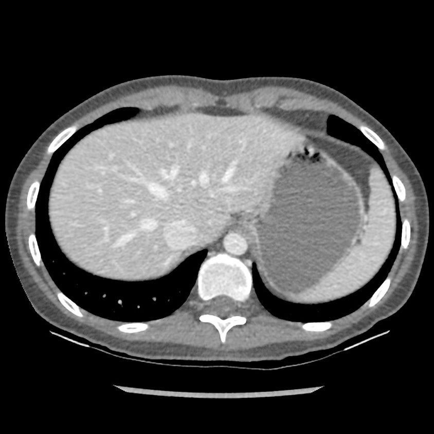 categoriescomputedtomographyrevolutionhdgehcrevolutionhdclinicalimagesbody1