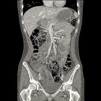 categoriescomputedtomographyrevolutionhdgehcrevolutionhdclinicalimagesbody2