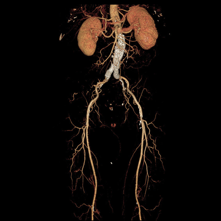categoriescomputedtomographyrevolutionhdgehcrevolutionhdclinicalimagesbody3