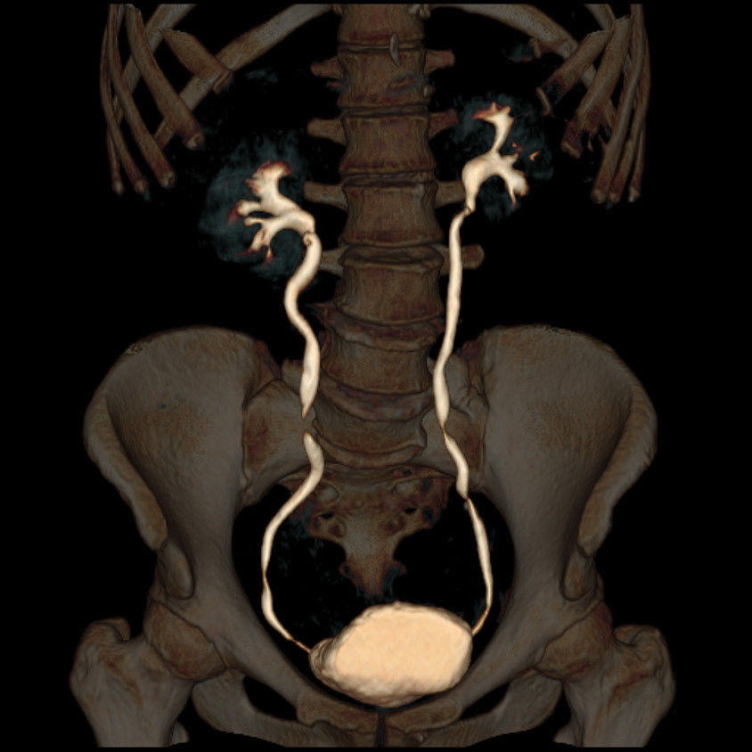 categoriescomputedtomographyrevolutionhdgehcrevolutionhdclinicalimagesbody5