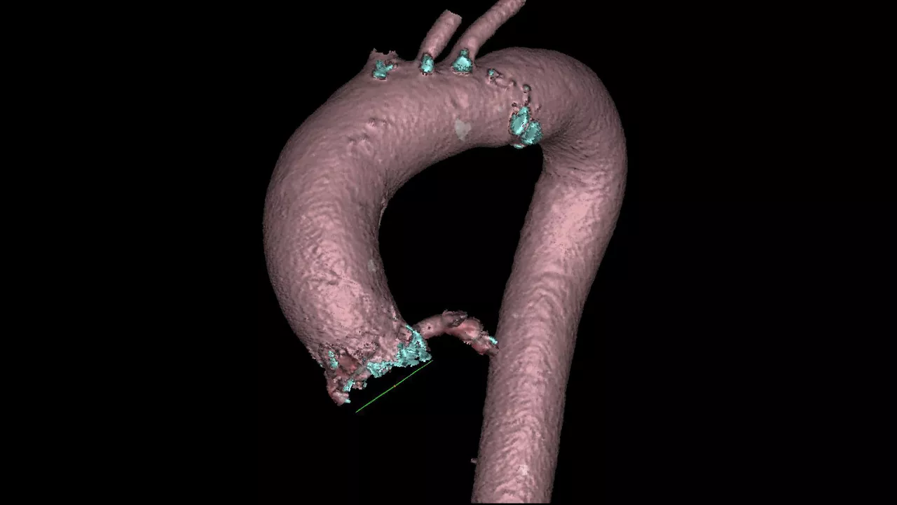 cations-valveplanning-valve-planning-clinical-valve-plan-automatic-optimal-projection