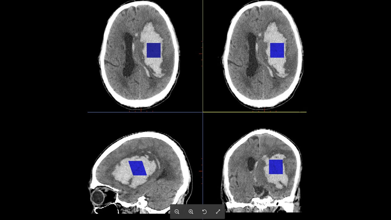cloneadvancedvisualizationapplicationsstrokevcarawstrokevcarclinicalimage4