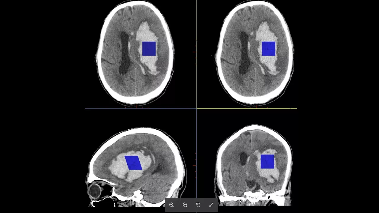 cloneadvancedvisualizationapplicationsstrokevcarawstrokevcarclinicalimage4