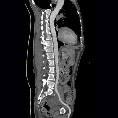 computed-tomography-discoverygsi-imagegallery-body-revolution-gsi-body-image31-thumb