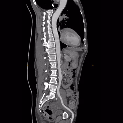 computed-tomography-discoverygsi-imagegallery-body-revolution-gsi-body-image31-thumb