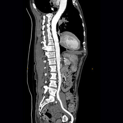 computed-tomography-discoverygsi-imagegallery-body-revolution-gsi-body-image32-thumb