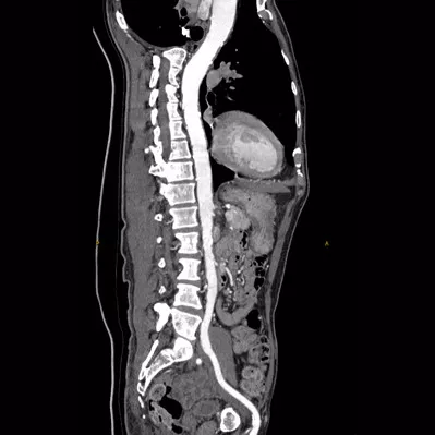 computed-tomography-discoverygsi-imagegallery-body-revolution-gsi-body-image32-thumb