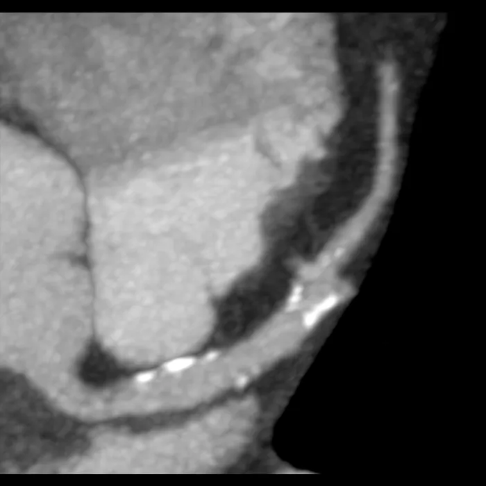 computed-tomography-discoverygsi-imagegallery-cardiac-revolution-gsi-cardiac-image50