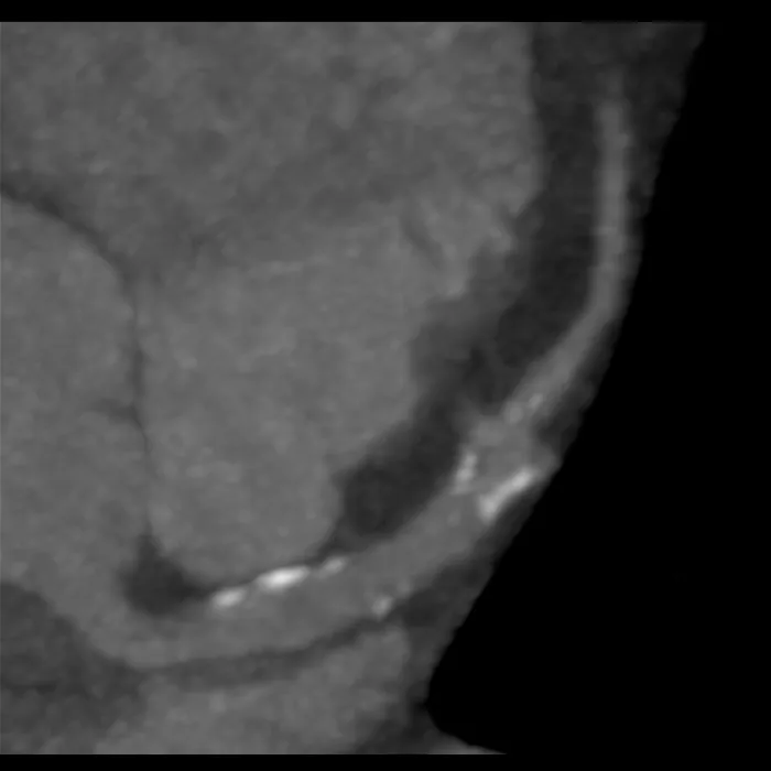 computed-tomography-discoverygsi-imagegallery-cardiac-revolution-gsi-cardiac-image51