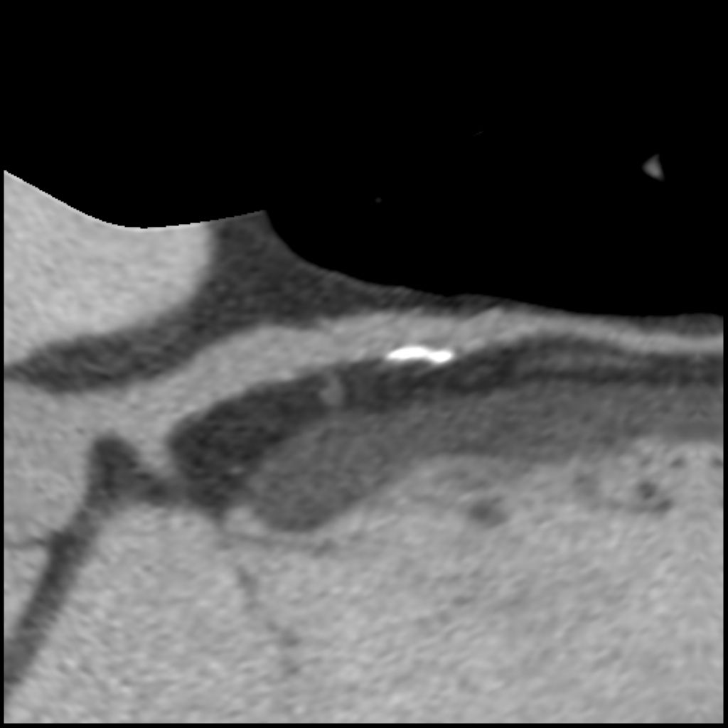 computed-tomography-discoverygsi-imagegallery-cardiac-revolution-gsi-cardiac-image52