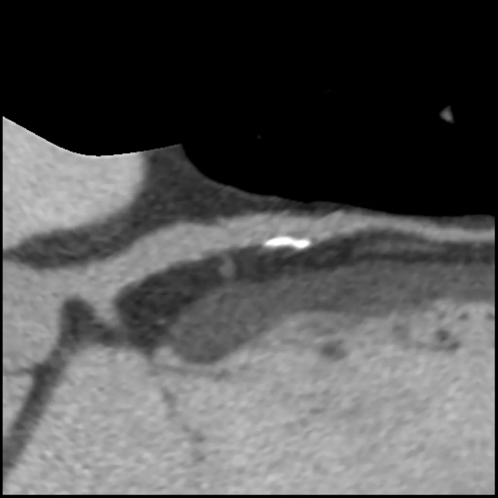 computed-tomography-discoverygsi-imagegallery-cardiac-revolution-gsi-cardiac-image52