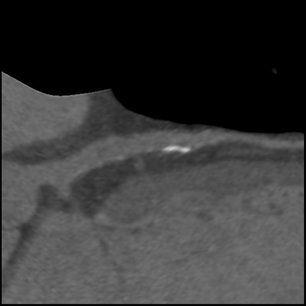 computed-tomography-discoverygsi-imagegallery-cardiac-revolution-gsi-cardiac-image53