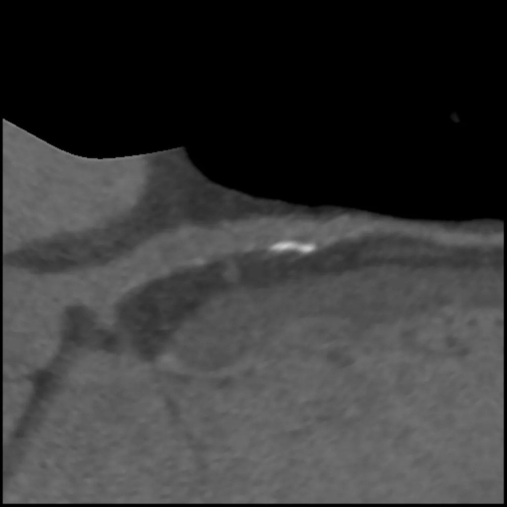 computed-tomography-discoverygsi-imagegallery-cardiac-revolution-gsi-cardiac-image53