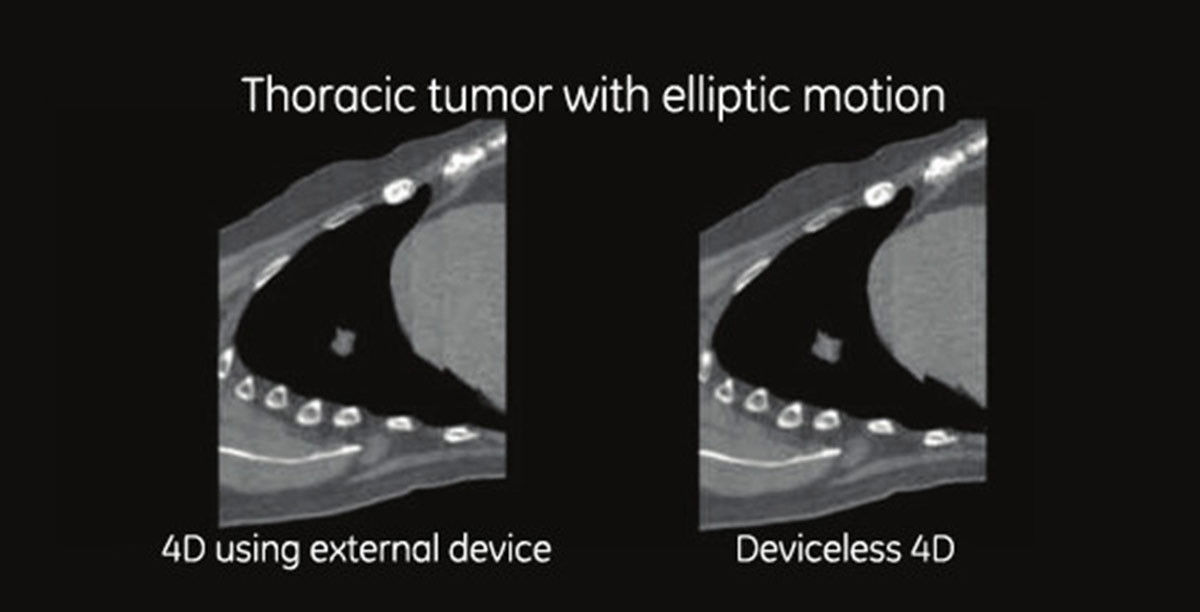 deviceless4d-gehc-smart-deviceless-4d-thoracic-tumor-with-elliptic-motion-spotlight