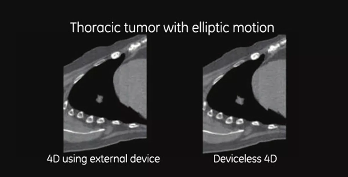 deviceless4d-gehc-smart-deviceless-4d-thoracic-tumor-with-elliptic-motion-spotlight
