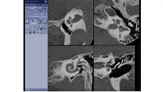 e-advanced-visualization-applications-innova-ct-hd-clinical-ge-awinnovacthd-cochlea