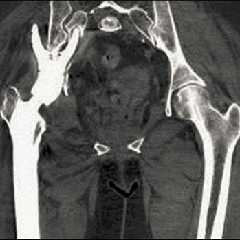 erygsi-imagegallery-musculoskeletal-gehc-revolution-gsi-clinical-image-msk-gsiimage