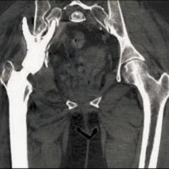 erygsi-imagegallery-musculoskeletal-gehc-revolution-gsi-clinical-image-msk-gsiimage