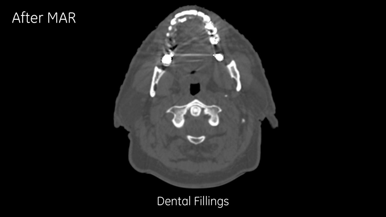 graphy-metal-artifact-reduction-image-gallery-dental-fillings-corrected-after-clinical