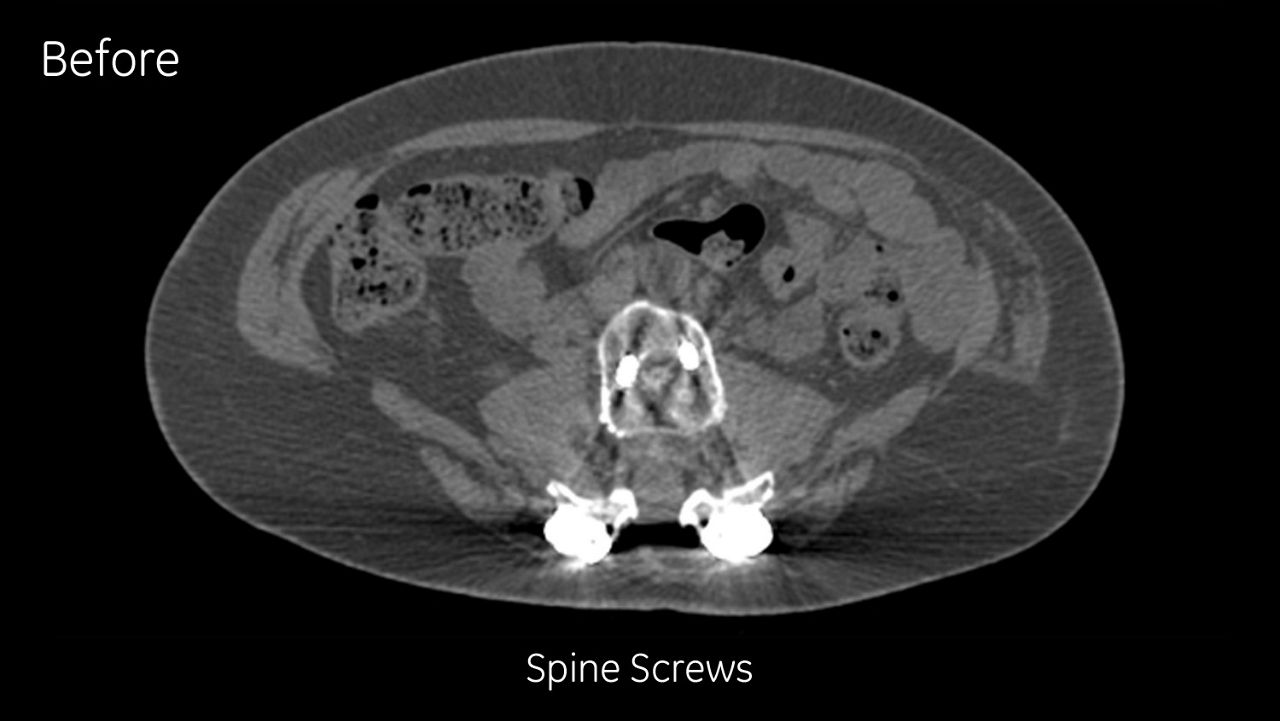 graphy-metal-artifact-reduction-image-gallery-spine-screws-uncorrected-before-clinical