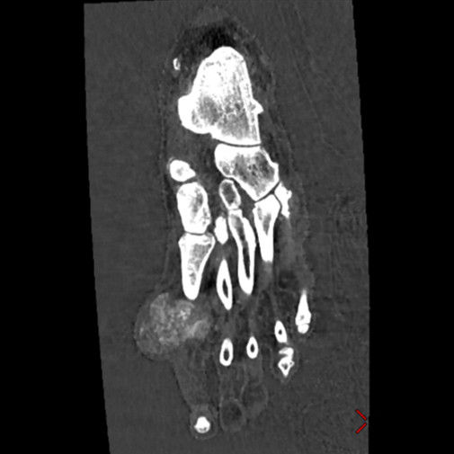 i-imagegallery-musculoskeletal-gehcrevolutiongsiclinicalimagemsk2mdcalciumuricacid