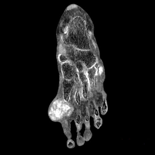 i-imagegallery-musculoskeletal-gehcrevolutiongsiclinicalimagemsk2mduricacidcalcium