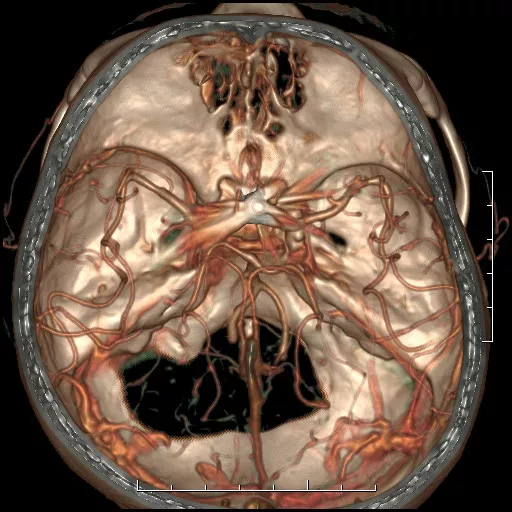 ies-computed-tomography-discoverygsi-imagegallery-neuro-revolution-gsi-neuro-image18