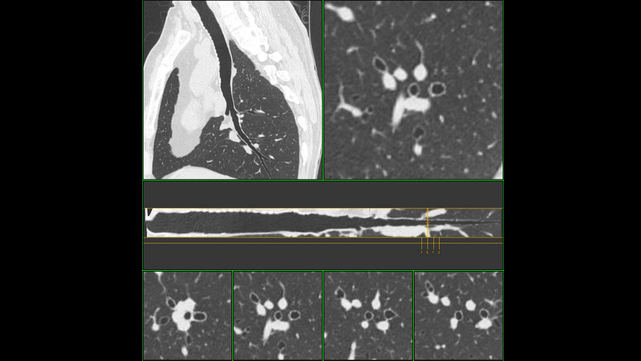 ion-applications-thoracic-vcar-image-gallery-aw-thoracic-vcar-airway-analysis-clinical