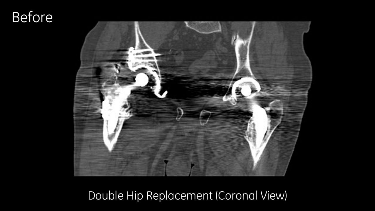 l-artifact-reduction-image-gallery-double-hip-replacement-coronal-view-before-clinical
