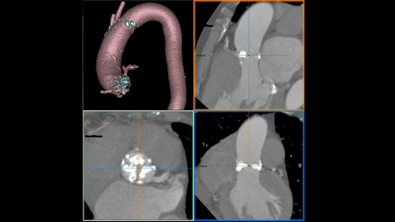 lization-applications-valveplanning-valve-planning-clinical-aortic-annulus-assessment