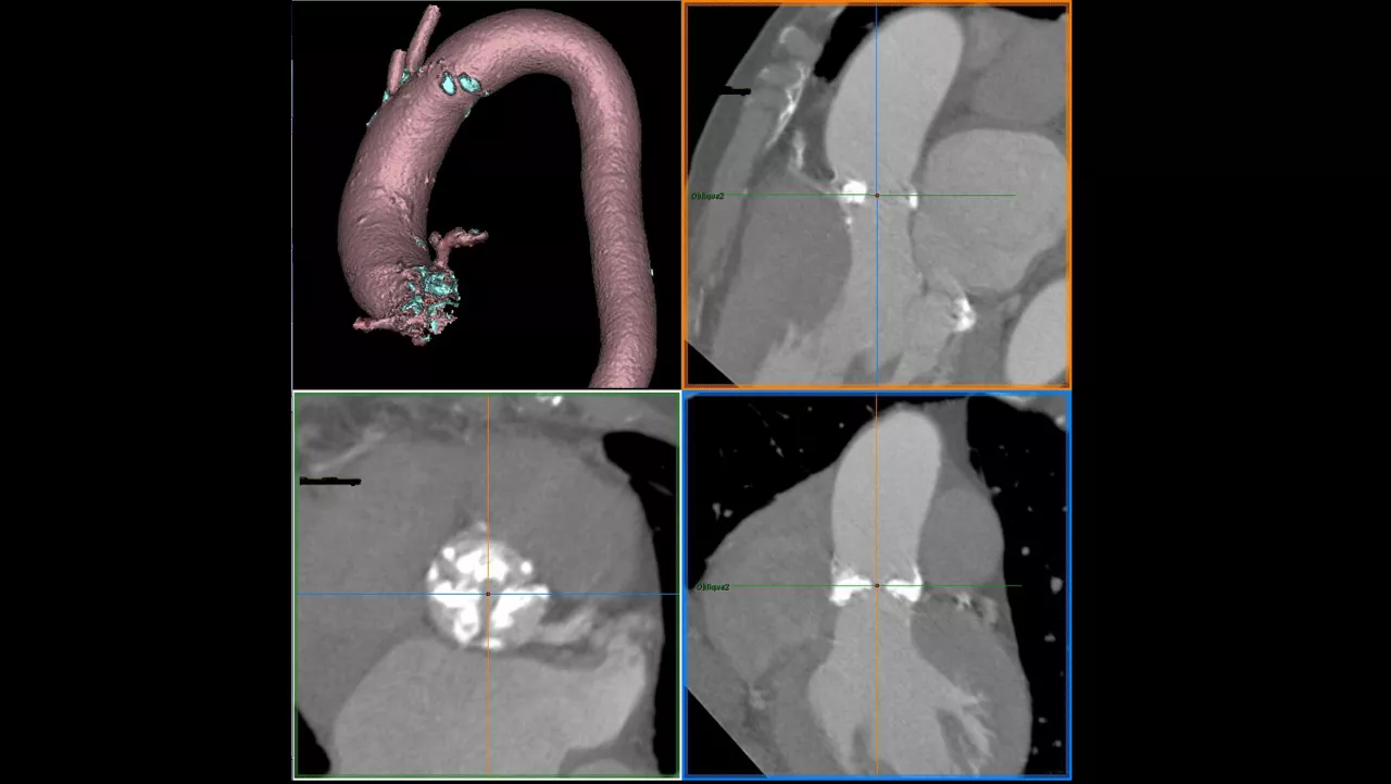 lization-applications-valveplanning-valve-planning-clinical-aortic-annulus-assessment