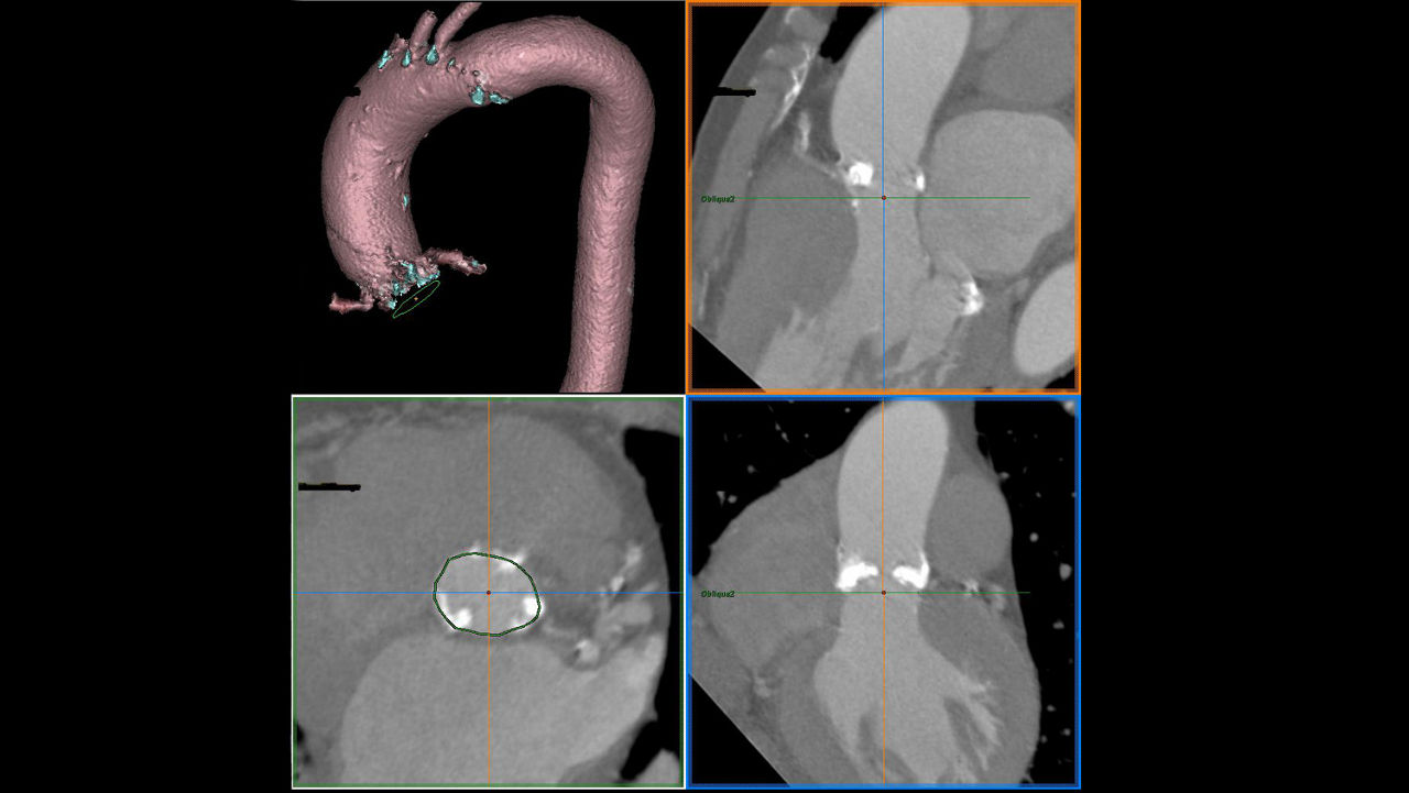 lization-applications-valveplanning-valve-planning-clinical-aortic-annulus-contouring