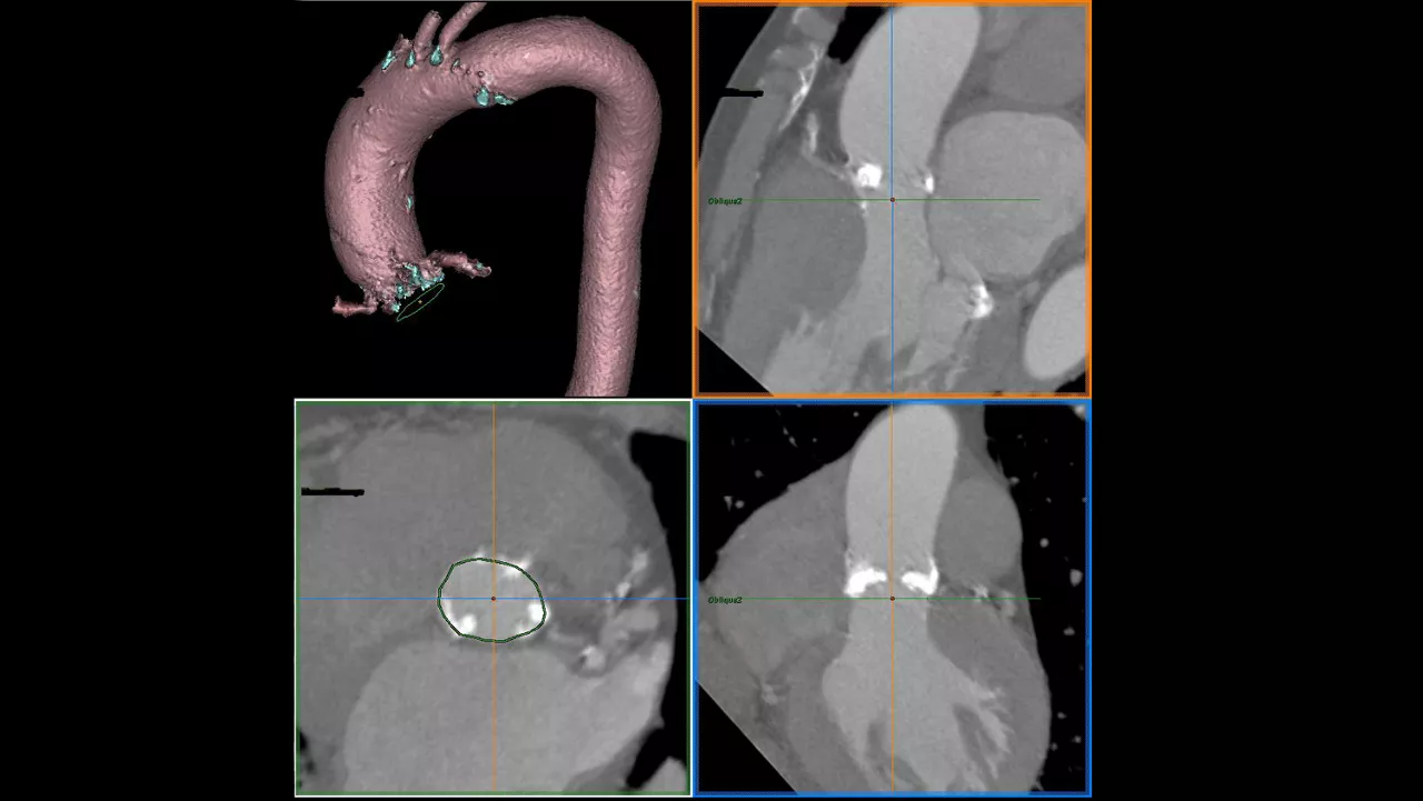 lization-applications-valveplanning-valve-planning-clinical-aortic-annulus-contouring