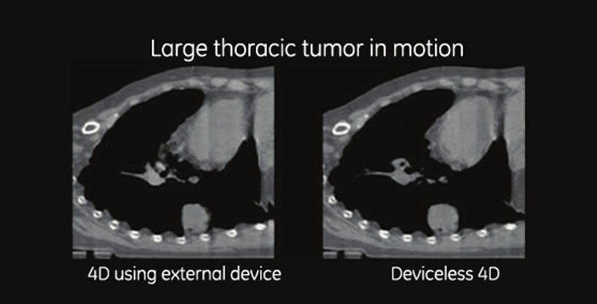 martdeviceless4d-gehc-smart-deviceless-4d-large-thoracic-tumor-in-motion2-spotlight