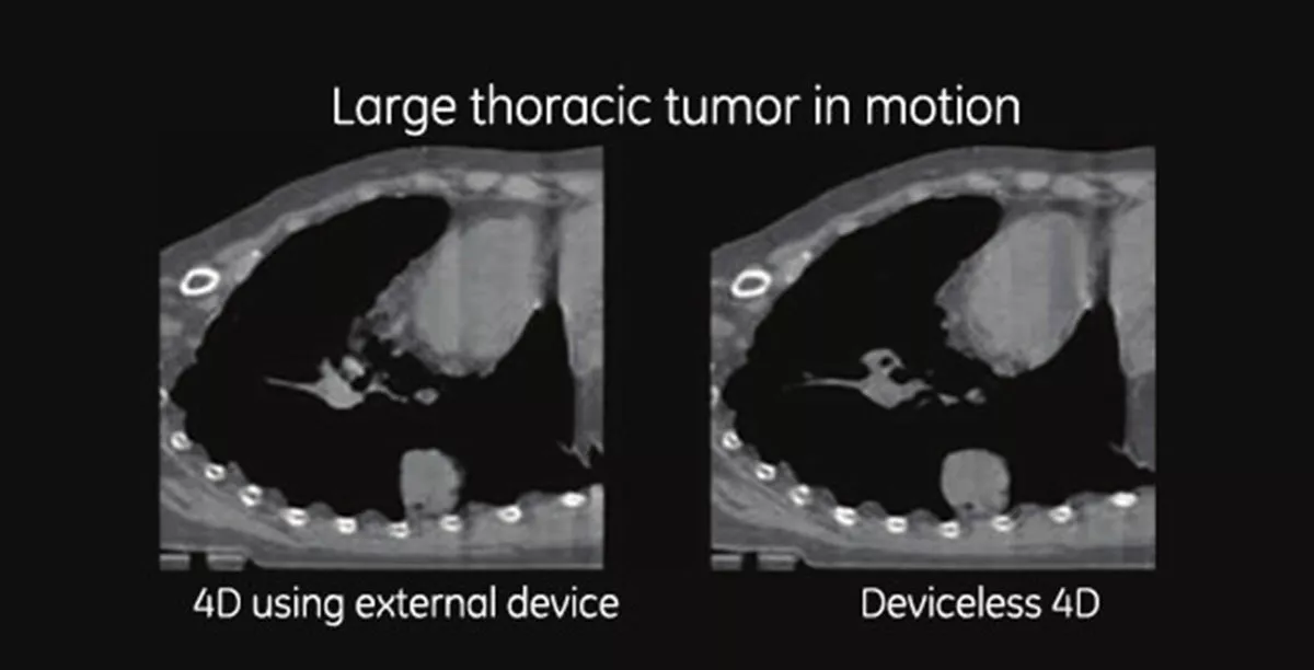 martdeviceless4d-gehc-smart-deviceless-4d-large-thoracic-tumor-in-motion2-spotlight