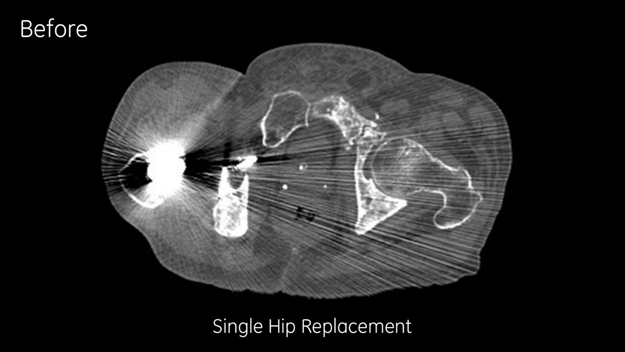 metal-artifact-reduction-image-gallery-single-hip-replacement-corrected-after-clinical
