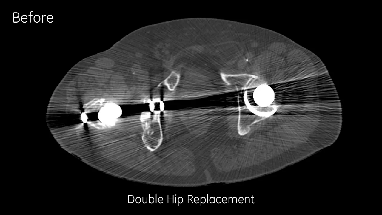 mography-metal-artifact-reduction-image-gallery-double-hip-replacement-before-clinical