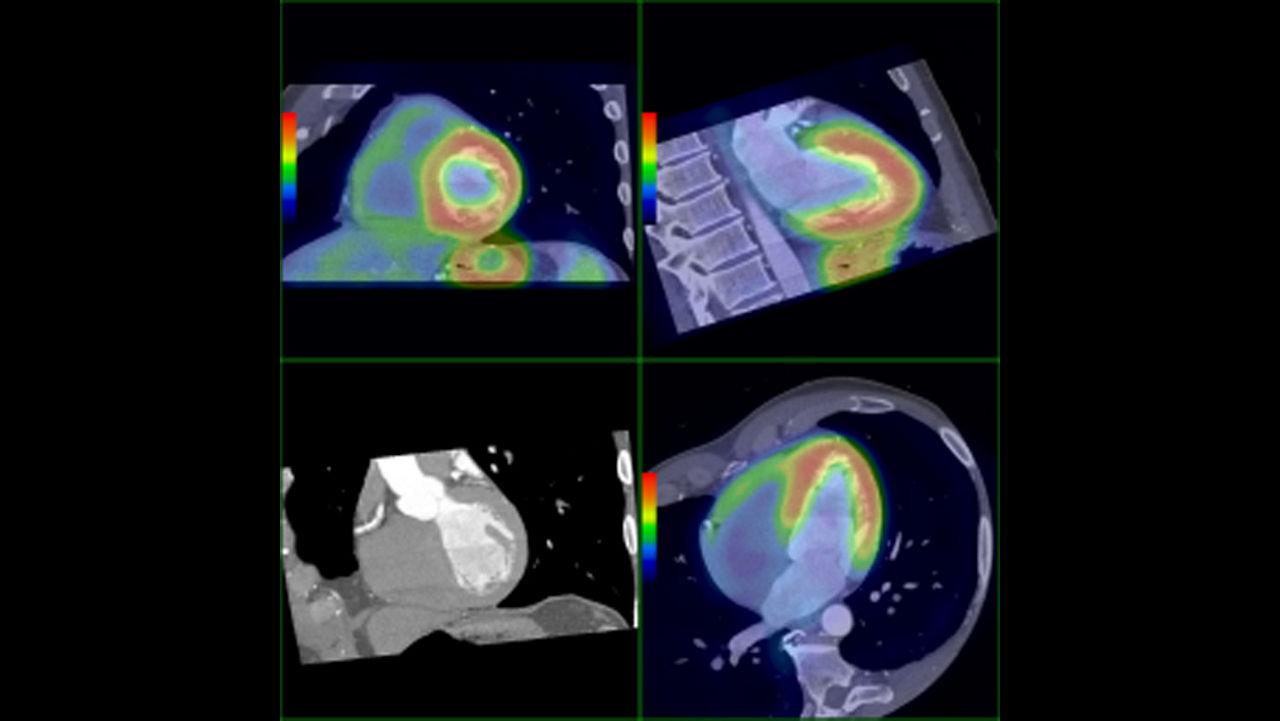 ne-advanced-visualization-applications-cardiqfusion-aw-cardiq-fusion-clinical-image-1