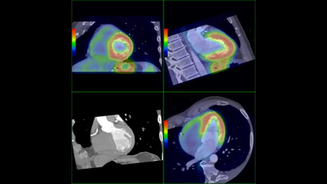 ne-advanced-visualization-applications-cardiqfusion-aw-cardiq-fusion-clinical-image-1