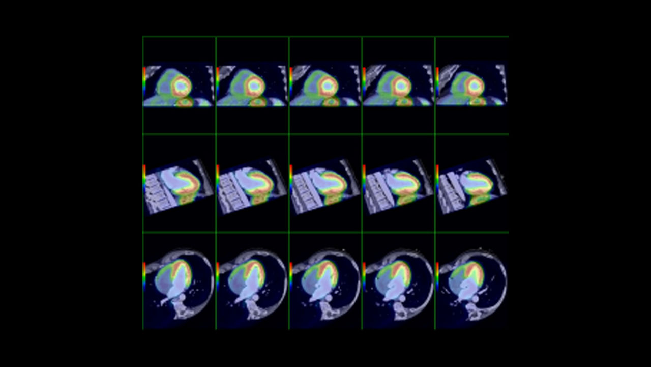 ne-advanced-visualization-applications-cardiqfusion-aw-cardiq-fusion-clinical-image-2